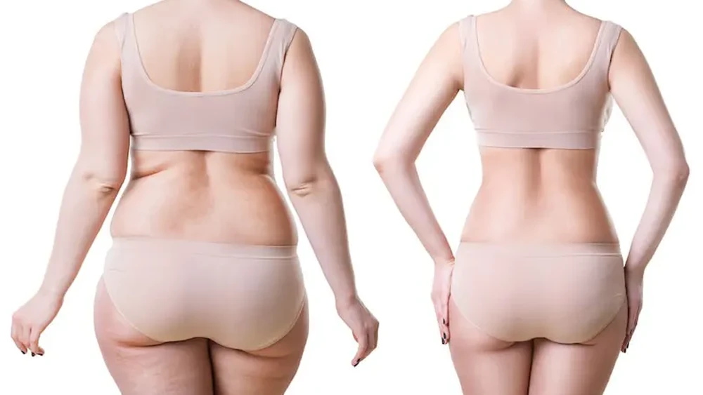 Liposuction Tedavisi