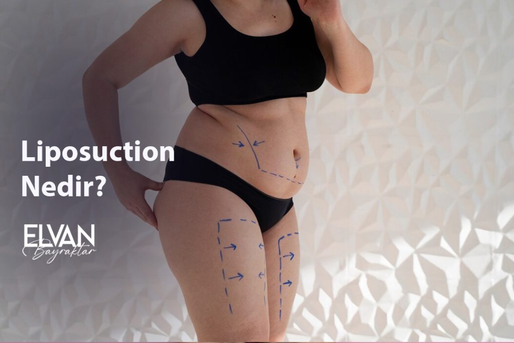 Liposuction Nedir?