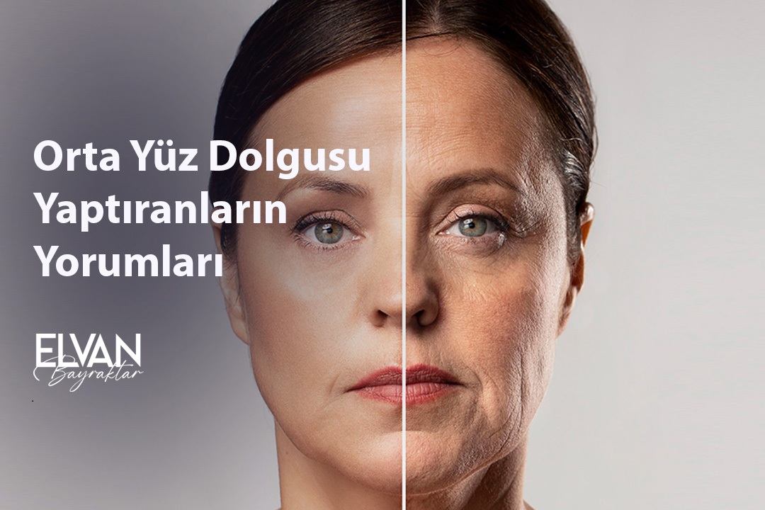Orta Yüz Dolgusu Yaptıranların Yorumları