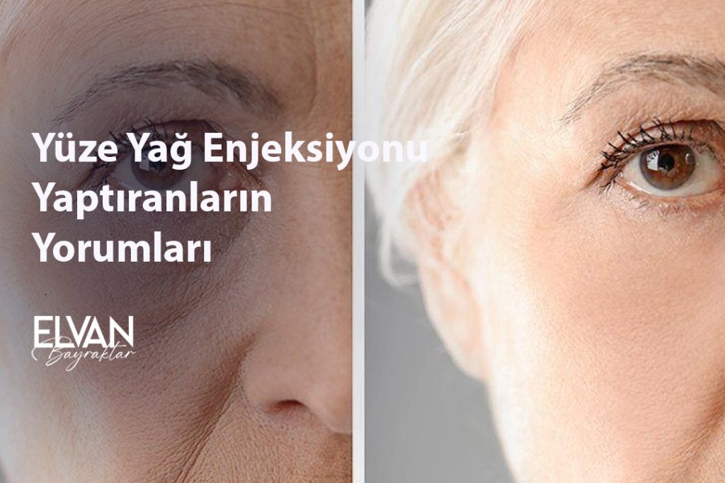 Comments of Those Who Have Facial Fat Injection