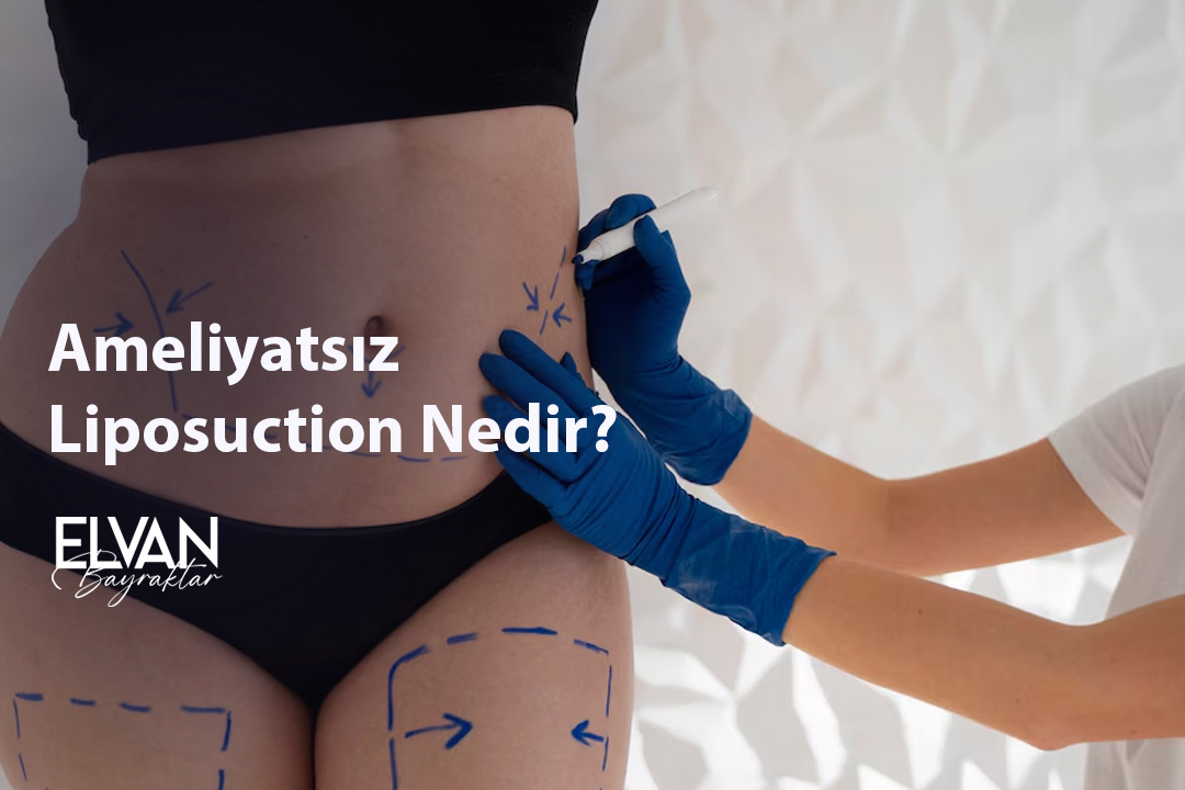 Ameliyatsız Liposuction Nedir