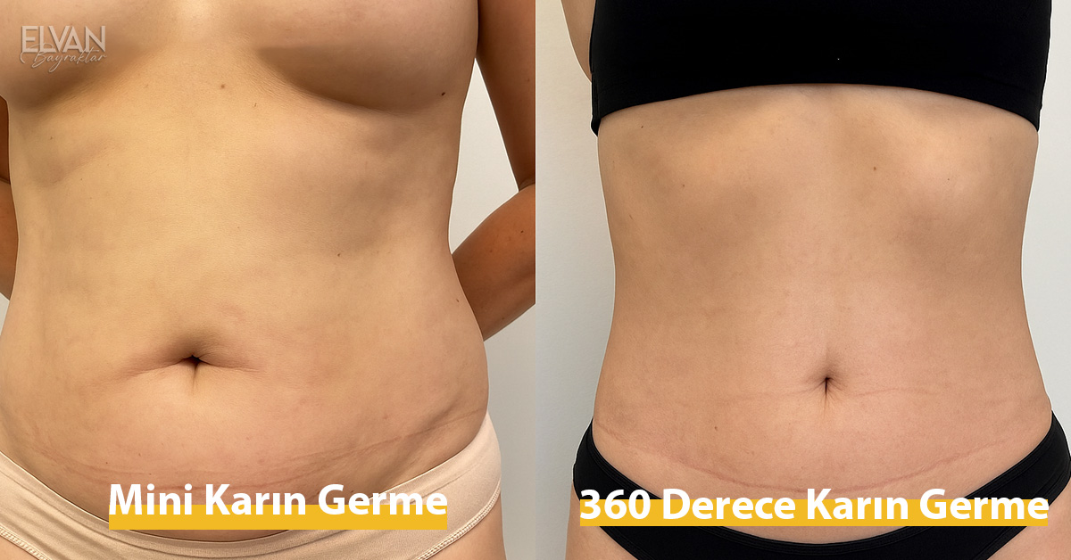 Mini Karın Germe ve 360 Derece Karın Germe Farkları