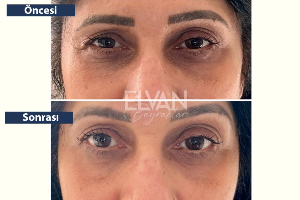 Öncesi ve Sonrası Değişimler (Before & After)