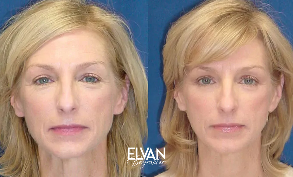 Ameliyatsız Tedavi Öncesi Sonrası Değişimler (Before & After)