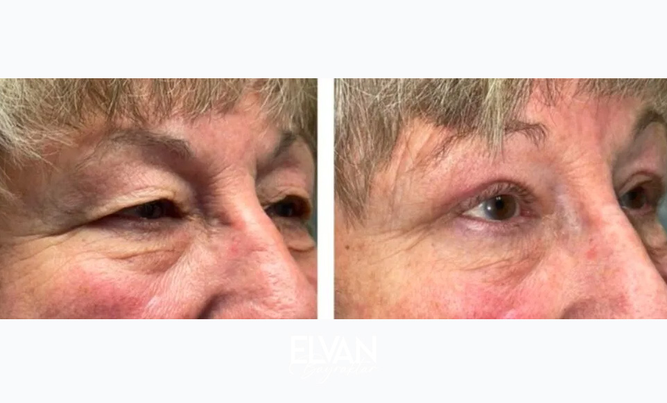 Ameliyatsız Tedavi Öncesi Sonrası Değişimler (Before & After)