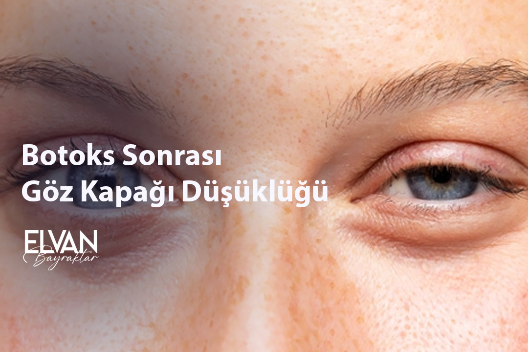 Botoks Sonrası Göz Kapağı Düşüklüğü