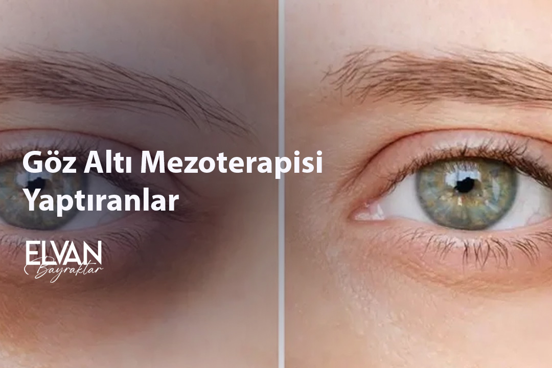 Göz Altı Mezoterapisi Yaptıranlar