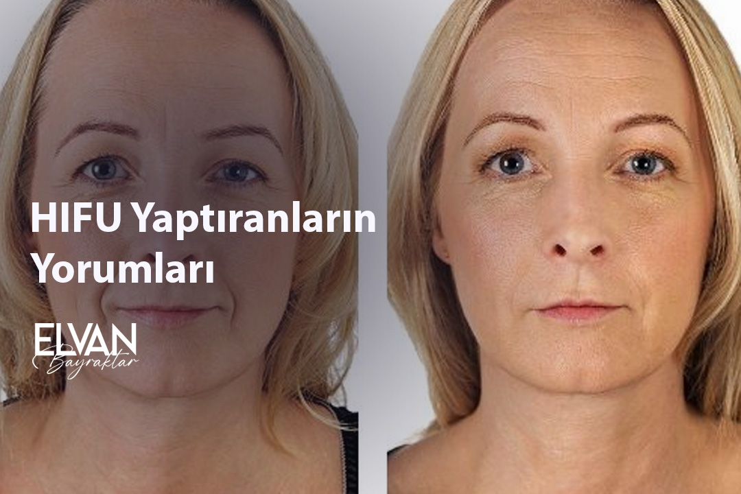 HIFU Yaptıranların Yorumları