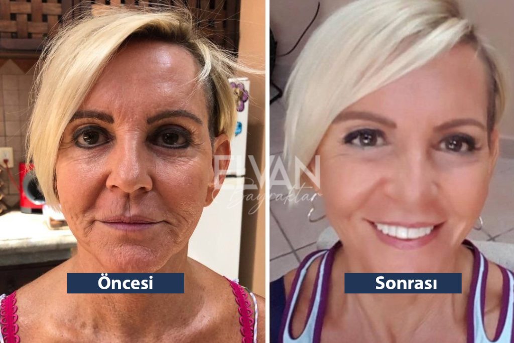 Uygulama Öncesi ve Sonrası Değişimler (Before & After)