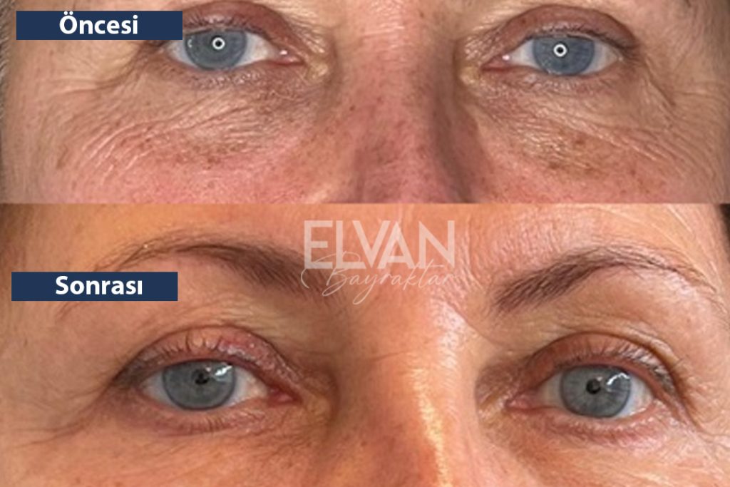 Öncesi ve Sonrası Değişimler (Before & After)