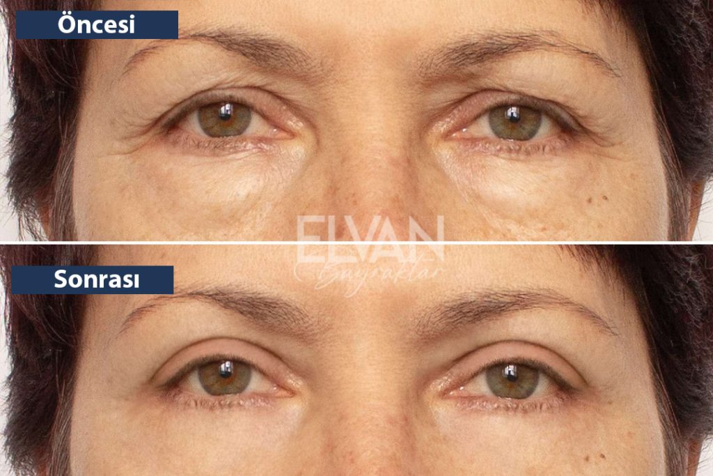 Öncesi ve Sonrası Değişimler (Before & After)