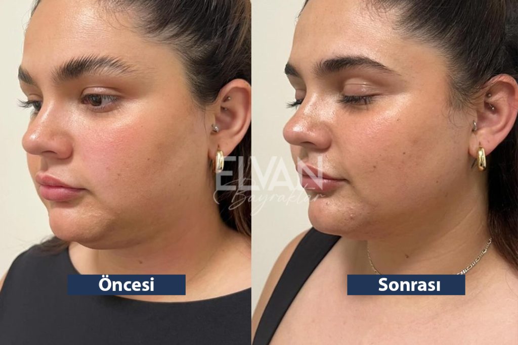 HIFU Öncesi ve Sonrası Değişimler (Before & After)