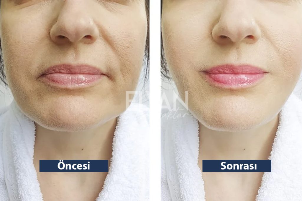 HIFU Öncesi ve Sonrası Değişimler (Before & After)