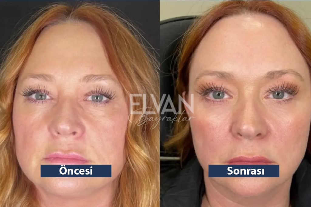 Uygulama Öncesi ve Sonrası Değişimler (Before & After)