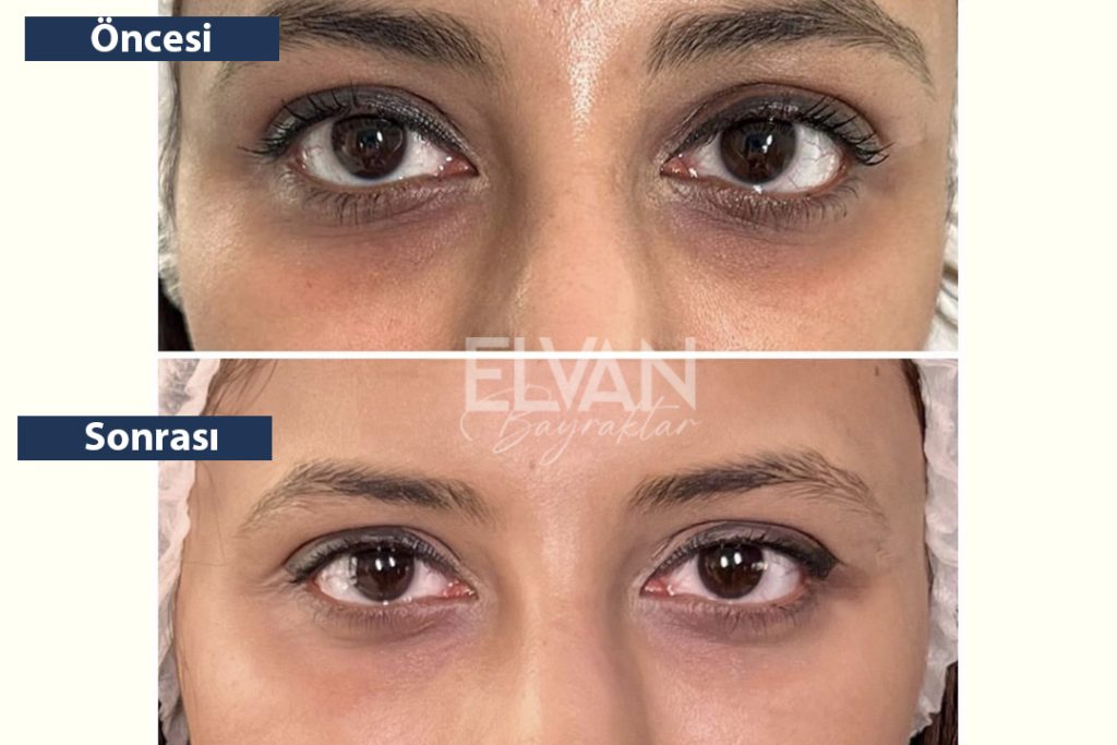 Öncesi ve Sonrası Değişimler (Before & After)