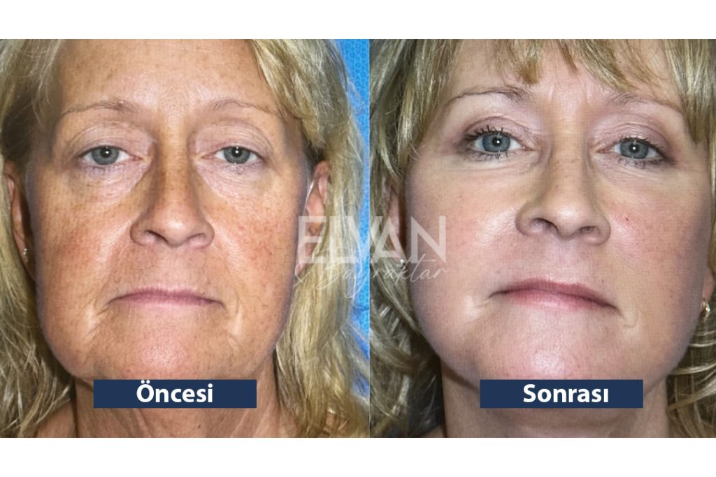 Uygulama Öncesi ve Sonrası Değişimler (Before & After)